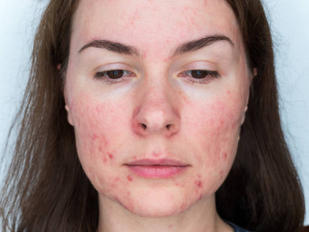 Discover if your acne is hormonal with our expert guide - Hormonal Acne: Symptoms, Causes, and Treatment