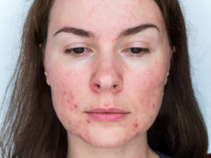 How to tell if acne is hormonal or bacterial